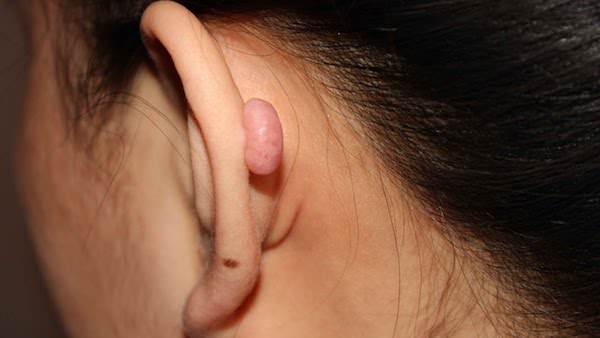 cartilage-piercing-bump.jpg